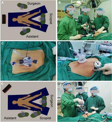 Feasibility and preliminary experience of single-incision plus one-port laparoscopic total gastrectomy with Overlap esophagojejunostomy for gastric cancer: A study of 10 cases
